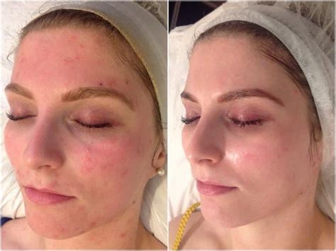 Acne Treatment For Sensitive Skin - Andy Millward - Facialist