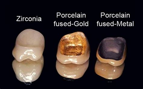 Metal Free Zirconia Crown v/s Porcelain Fused to Metal Crown | Dr ...