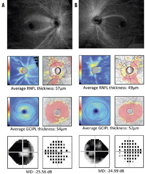 Retinal Nerve Fiber Layer Optical Texture Analysis - Glaucoma Today