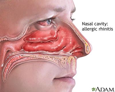 Allergic rhinitis: MedlinePlus Medical Encyclopedia