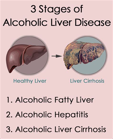 Alcoholic Liver Disease Symptoms, Stages, Treatment - Summit Rehab