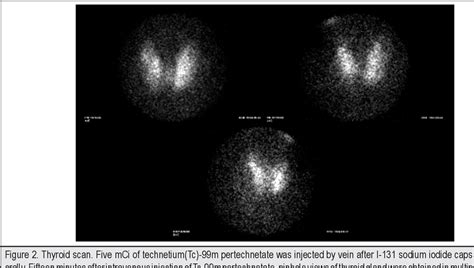 Figure 2 from Toxic multinodular goiter in a patient with end-stage ...