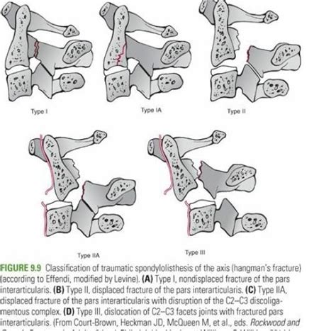 Hangman’s Fracture - RayOrthos