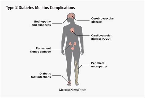 Potential complications of type 2 diabetes