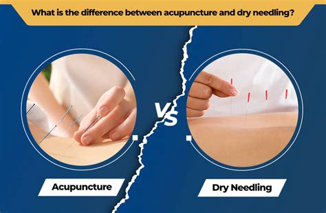 Know The Difference Between Dry Needling and Acupuncture