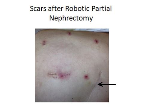 Robotic Partial Nephrectomy | Stony Brook University School of Medicine