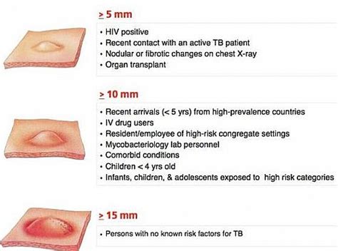 การแปลผล TB SKIN TEST ในต่างประเทศ - ถาม พบแพทย