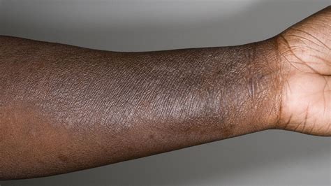 Why Doctors Misdiagnose Skin of Color