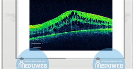 Cystoid macular oedema - Meduweb