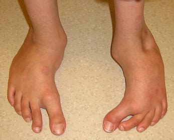 Pigeon toes, also called metatarsus varus, metatarsus adductus, in-toe gait, intoeing or false ...