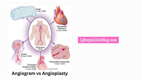 Angiogram vs Angioplasty: What’s the Difference?