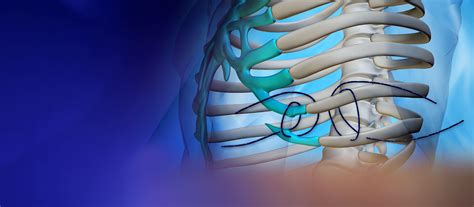 Floating Rib Syndrome Mayo Clinic