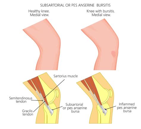 Pes Anserine Bursitis | Pes Anserine Bursitis Exercises