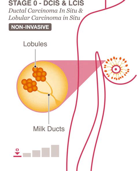 Stages 0 & 1 Breast Cancer Overview - National Breast Cancer Foundation