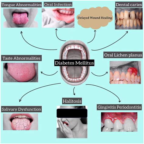 Complications of oral cavity in diabetes mellitus. | Download Scientific Diagram