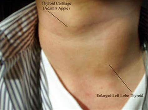 Enlarged / Swollen Thyroid - Symptoms, Causes, Treatment, Pictures