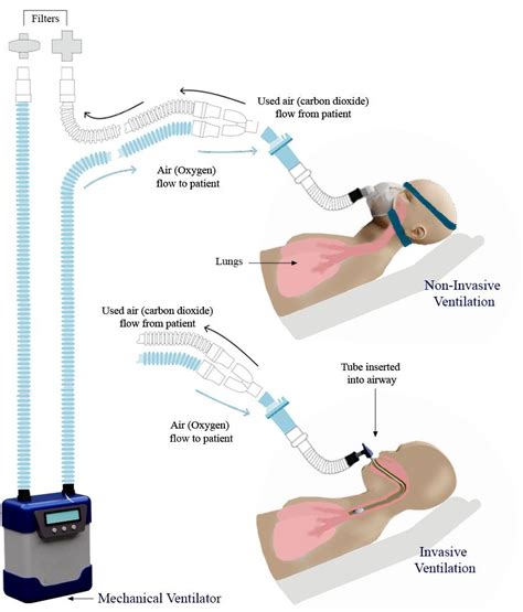 Ventilator / Ventilator Shortages Possible As Covid 19 Spreads In U S Shots Health News Npr ...