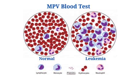 MPV Blood Test: Calculation, High and Low MPV Value, Results - PhD Nest