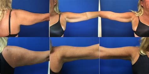 Laser Lipo Arms Before And After