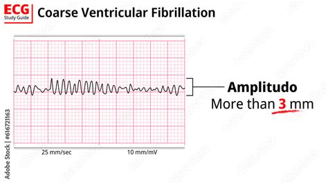 ECG Coarse Ventricular Fibrillation - Electrocardiogram Study Guide ...