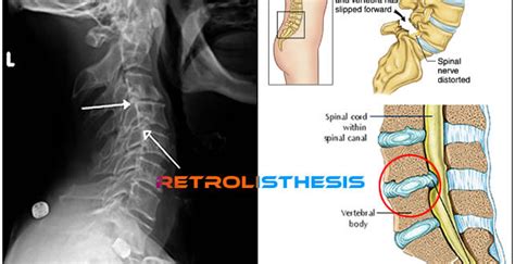 Retrolisthesis - Treatment, Causes, Symptoms, Definition