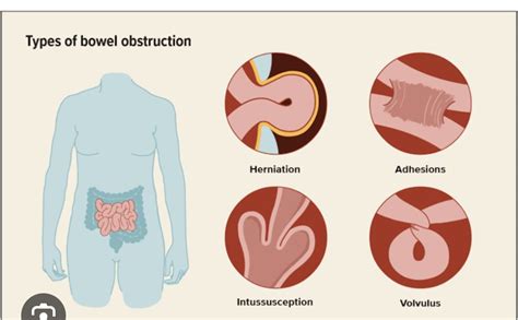 Small Bowel Obstruction: Causes, Symptoms & Treatment. - Dr AvinashTank ...