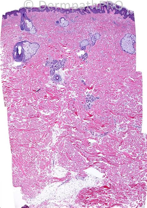 Case 818 - 6th August - August 2013 - DermpathPRO