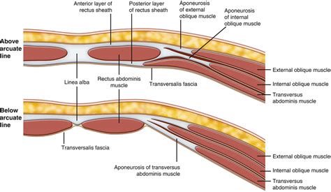 Ventral Hernia Abdomen