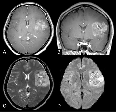 Case 1. A 47-year-old female with anaplastic oligodendroglioma.... | Download Scientific Diagram