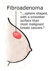 Fibroadenoma - Symptoms, Causes, Pictures, Removal and Treatment