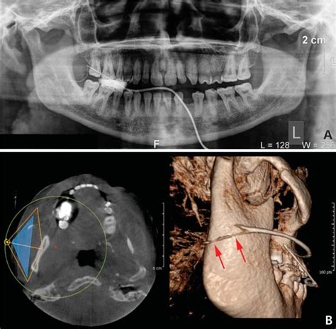 A. Panoramic sialogram shows stenosis of the right Stensen's duct. B.... | Download Scientific ...