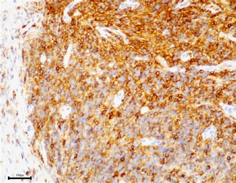 Immunohistochemical profile of the lymphocytic proliferation showing ...