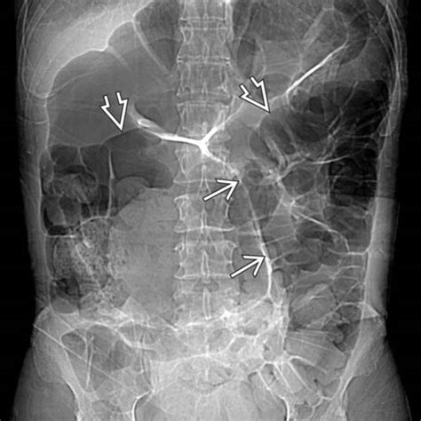 Sigmoid Volvulus | Clinical Gate