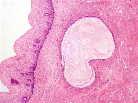 Diseases of the Cervix | Basicmedical Key