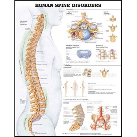 Human Spine Disorders Anatomical Chart - Chiro1Source