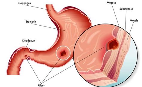 Curling ulcer causes, signs, symptoms, diagnosis, treatment & prognosis