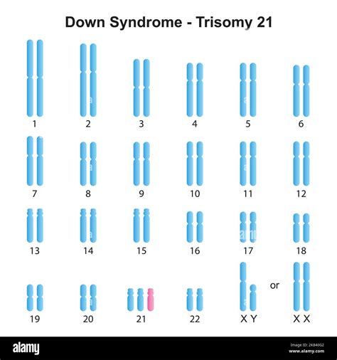 Scientific Designing of Down Syndrome (Trisomy 21) Karyotype. Colorful ...