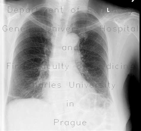 Radiology case: Kerley lines B