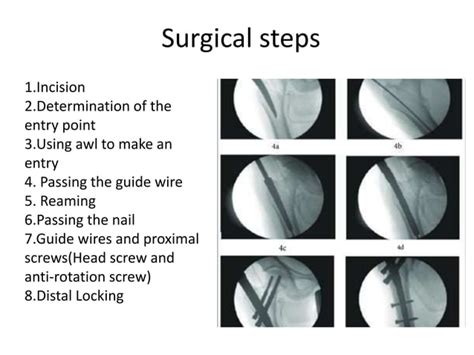 Tips, tricks and pitfalls of proximal femoral nailing (PFN)