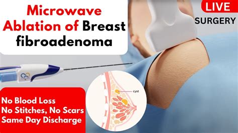 Microwave Ablation of Breast fibroadenoma | Non Surgical Treatment | Without Surgery - YouTube