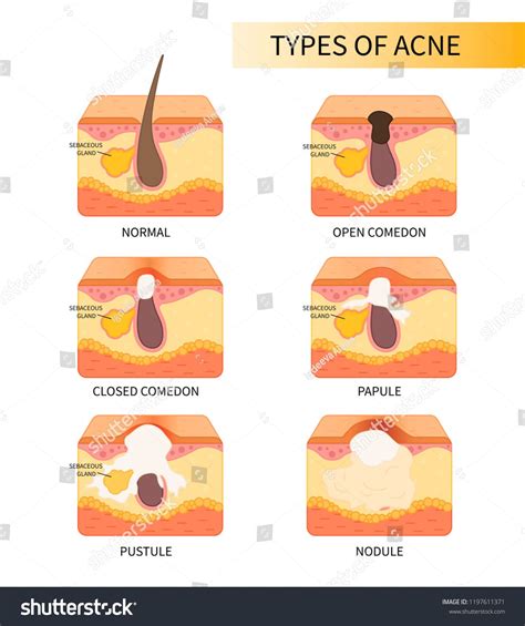 Anatomical schemeof different types of acne. Structure of pimple,types# ...