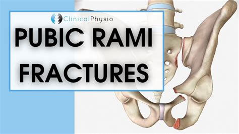 Superior Pubic Ramus Fracture