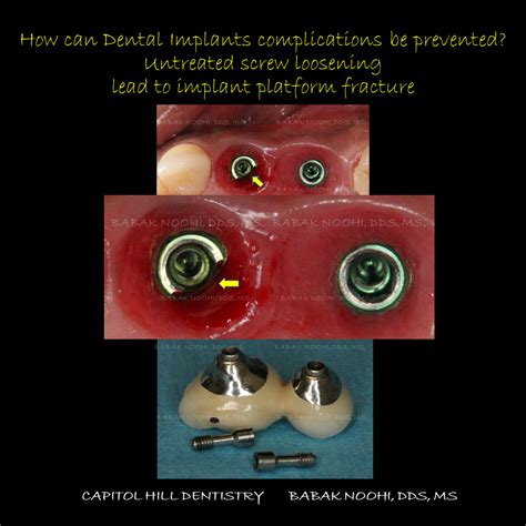 Dental Implant Complications. Can they be prevented? - Capitol Hill ...