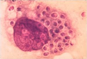 Histoplasmosis Symptoms, Causes, Diagnosis and Treatment - Natural ...