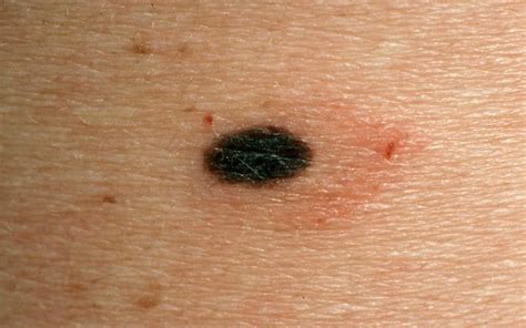 Moles - Causes, Types, Abnormal, Cancerous Moles