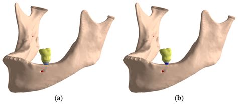 Jaw three-dimensional model: (a) Jaw with teeth; (b) edentulous jaw ...