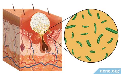 The Role of Bacteria in Acne - Acne.org