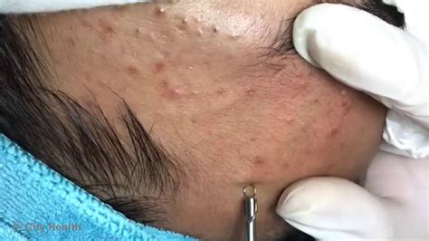 Satisfying Blackhead 2019 - Blackheads Removal - YouTube