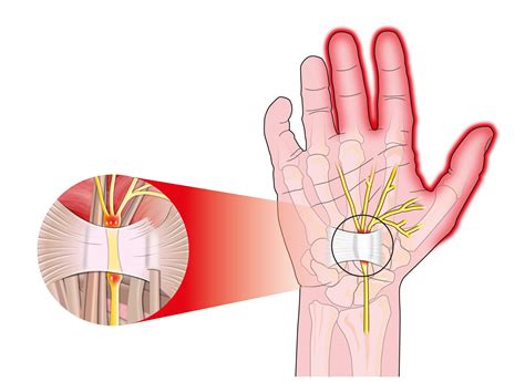 Carpal Tunnel Syndrome - Raleigh Hand Surgery — Joseph J. Schreiber, MD