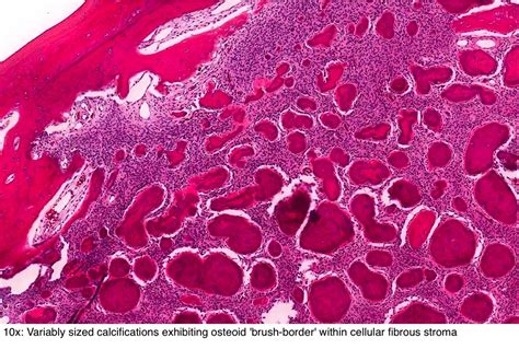 Pathology Outlines - Cemento-ossifying fibroma / ossifying fibroma